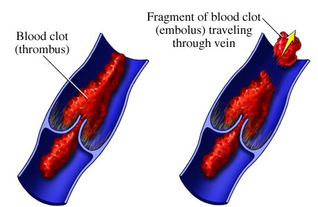 HVIembolism.jpg